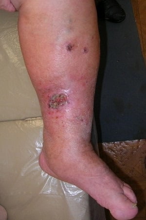 Болячки на ногах лечение в домашних условиях thumbnail