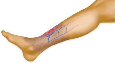 Трофическая язва сухая ноги лечение thumbnail