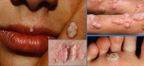 Вирус папилломы человека на коже у женщин лечение