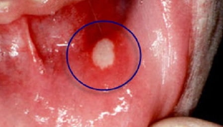 Что такое стоматит у взрослых фото симптомы и лечение thumbnail