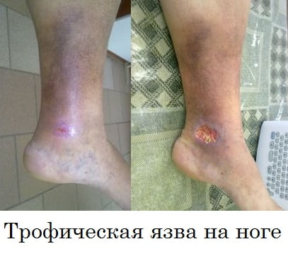 Трофическая язва на ноге лечение не открытая рана thumbnail