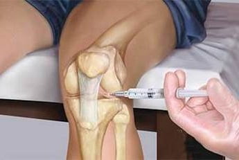 Синовит коленного сустава признаки лечение